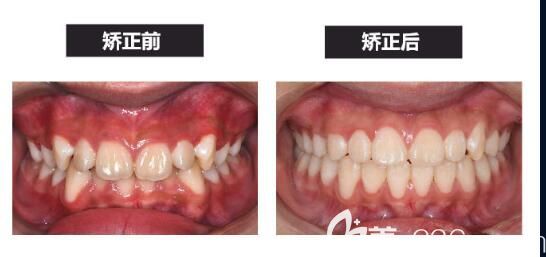 申晶院长深覆合矫正案例 申晶院长深覆合矫正案例