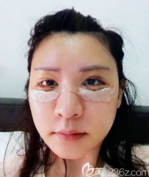 韩国BIO整形医院眼部修复案例术后2天效果图