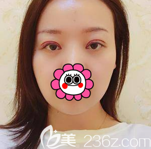 黄海滨给我做眼综合术后当天照