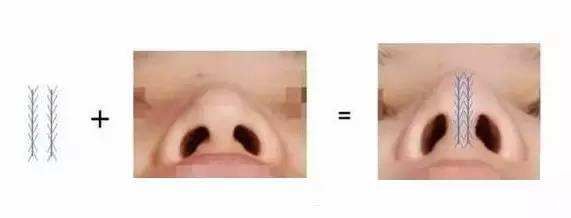 埋线对于鼻子的塑造