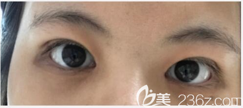 韩国soonplus做了埋线双眼皮+提肌+内眼角真人案例 韩国soonplus做了埋线双眼皮+提肌+内眼角真人案例