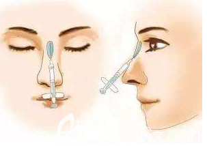 玻尿酸隆鼻