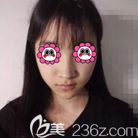 在长沙做鼻综合术前照 在长沙做鼻综合术前照