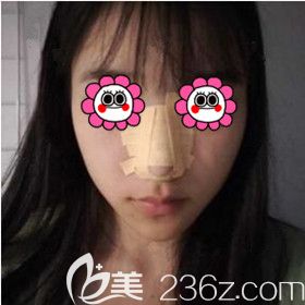 在长沙梵童做鼻综合术后1天照 在长沙梵童做鼻综合术后1天照