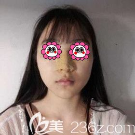 在梵童医疗美容做鼻综合术后5天<span style= 在梵童医疗美容做鼻综合术后5天<span style=