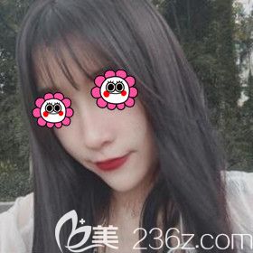 做完鼻综合术后30天恢复<span style= 做完鼻综合术后30天恢复<span style=