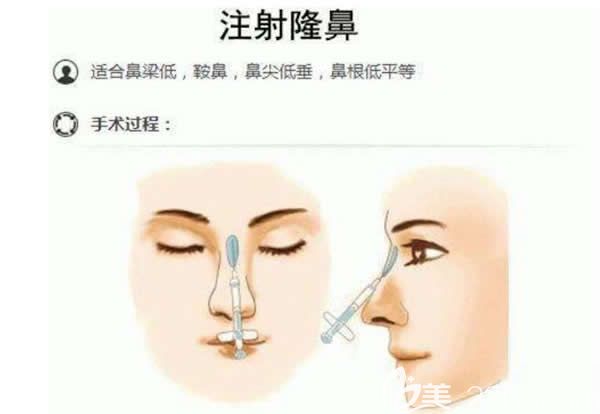 注射玻尿酸隆鼻示意图