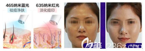 光子嫩肤去痘印效果明显