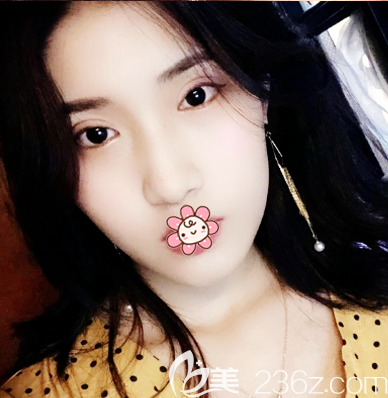 之所以来珠海新颜找苏锦和做双眼皮是因为身边好几个朋友都是找他做的眼睛效果很自然