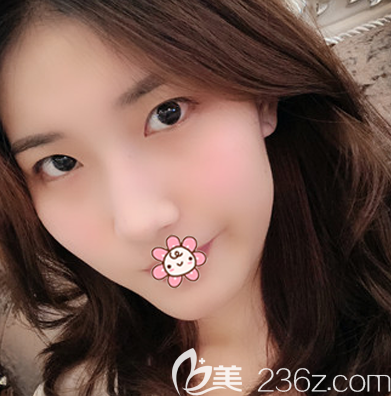 在珠海新颜做双眼皮术前照片 在珠海新颜做双眼皮术前照片