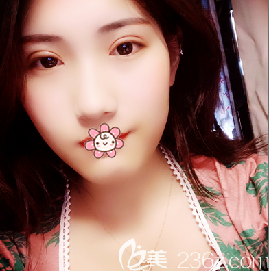 珠海新颜苏锦和双眼皮15天<span style= 珠海新颜苏锦和双眼皮15天<span style=