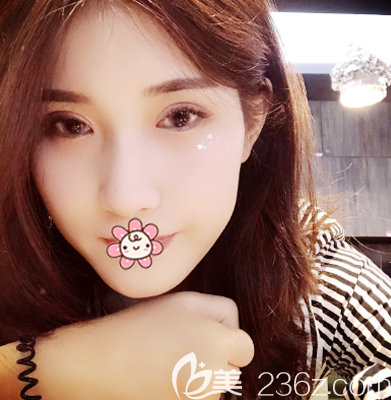 珠海双眼皮一个月<span style= 珠海双眼皮一个月<span style=