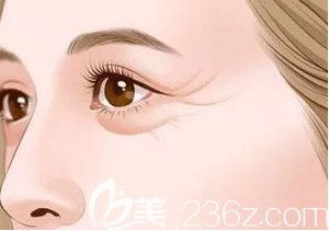 有眼袋的眼部示意图
