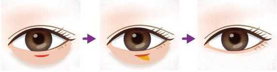 内切祛眼袋手术图