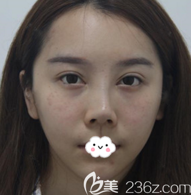 去珠海新颜做隆鼻修复术前照片 去珠海新颜做隆鼻修复术前照片