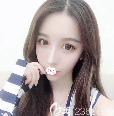 看完珠海正规隆鼻整形医院排名后找珠海新颜苏锦和院长做了隆鼻失败修复手术