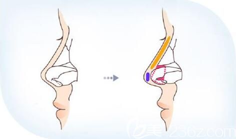 鼻小柱延长一般用什么材料 鼻小柱延长一般用什么材料
