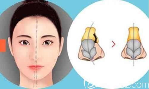 鼻小柱延长用那个材料好? 鼻小柱延长用那个材料好?