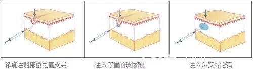 玻尿酸填充脸颊的手术步骤简易图