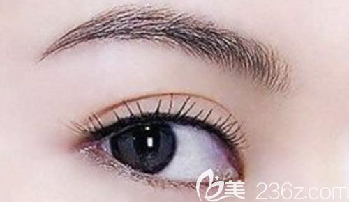 切开双眼皮效果图