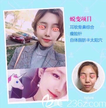 洛阳爱尚耳软骨隆鼻案例