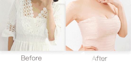 杭州美莱暑期整形季价格低到68折 隆胸医生栗勇假体丰胸15800元起