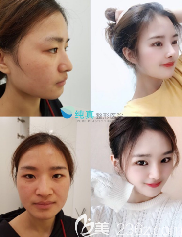 韩国纯真整形医院鼻综合隆鼻案例前后效果对比图