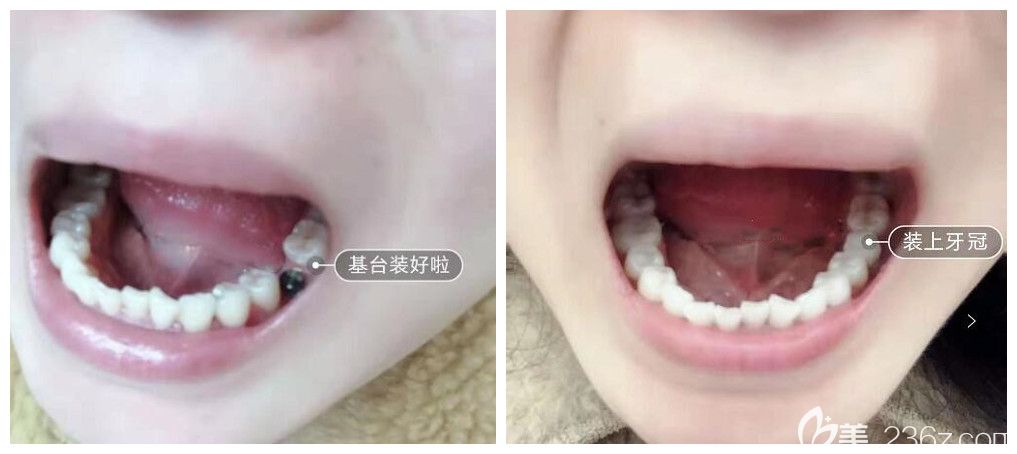 深圳圣浩口腔单颗种植牙案例