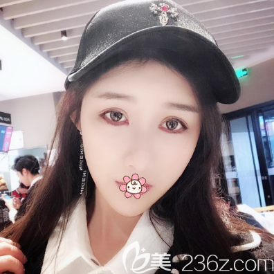 佛山华美祛眼袋术后10天效果图