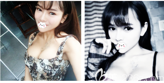 东莞美立方做玉兔动感隆胸怎么样