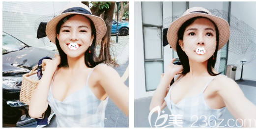 玉兔动感隆胸术后一个月效果