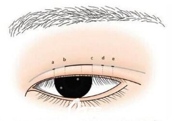 全切双眼皮多久能修复