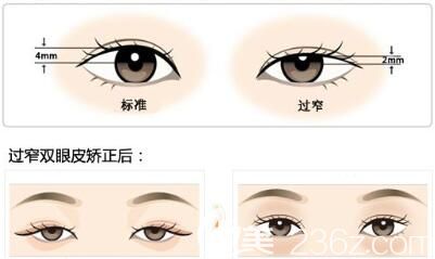 全切双眼皮修复术后注意事项