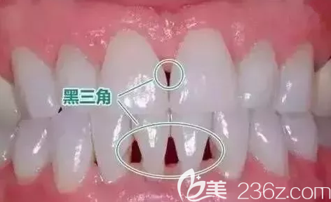 黑三角