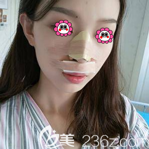 黄海滨医生给我做耳软骨隆鼻第3天样子