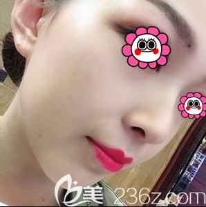 北京圣嘉新耳软骨鼻综合隆鼻案例