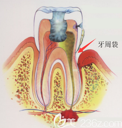注意牙周袋深度超过4mm你可能需要做龈下刮治或者手术
