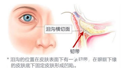 眼部出现泪沟的原理图