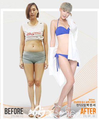韩国365mc吸脂医院案例 韩国365mc吸脂医院案例