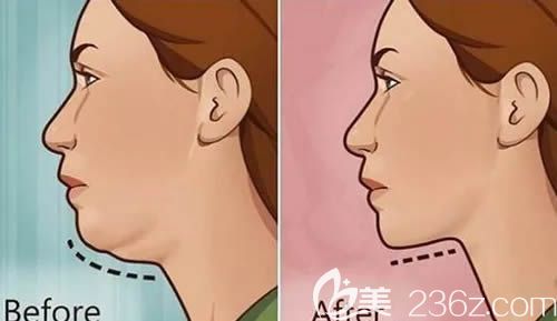 高新丹医生解答牙齿矫正是否会改变脸型