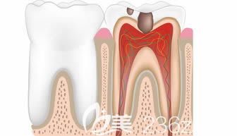 王入义医生科普牙髓炎知识 王入义医生科普牙髓炎知识