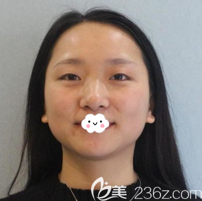 手术前眼睛形状有点三角眼 手术前眼睛形状有点三角眼