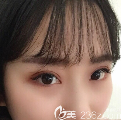 以前的三角眼，在张玲做完双眼皮开眼角手术后再也不凶了