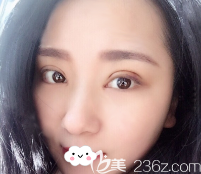 张玲双眼皮开眼角术后3天 张玲双眼皮开眼角术后3天