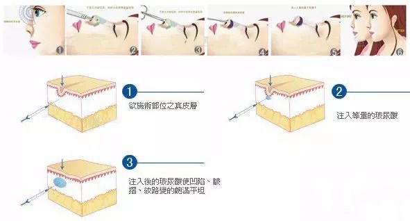 玻尿酸隆鼻图解