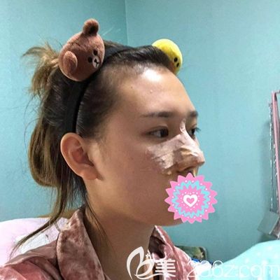 洛阳华美肋骨隆鼻术后3天 洛阳华美肋骨隆鼻术后3天