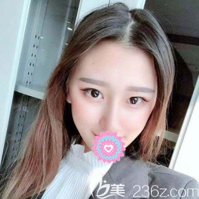 洛阳华美肋骨隆鼻术后25天 洛阳华美肋骨隆鼻术后25天