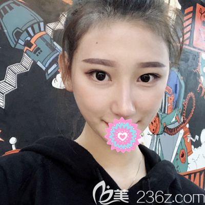 洛阳华美肋骨隆鼻术后30天 洛阳华美肋骨隆鼻术后30天