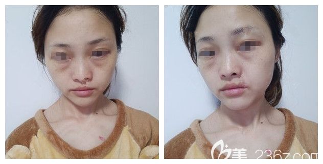 术前脸上斑点较多,主要为黄褐斑 术前脸上斑点较多,主要为黄褐斑