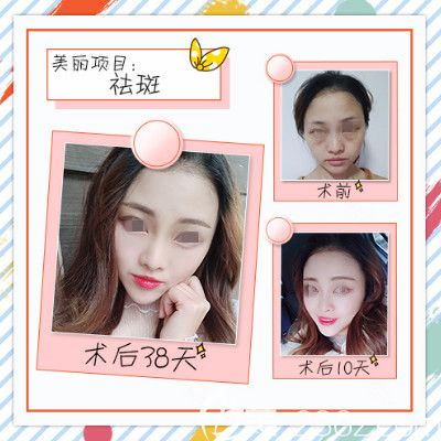 辉煌360去除黄褐斑术后蜕变效果 辉煌360去除黄褐斑术后蜕变效果